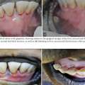 Eficácia da virginiamicina no controle da doença periodontal em bezerros.